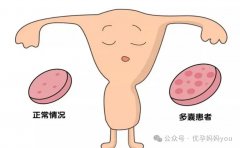泰國(guó)試管機(jī)構(gòu)案例分享：多囊困擾備孕六年，胚胎移植圓夢(mèng)成功