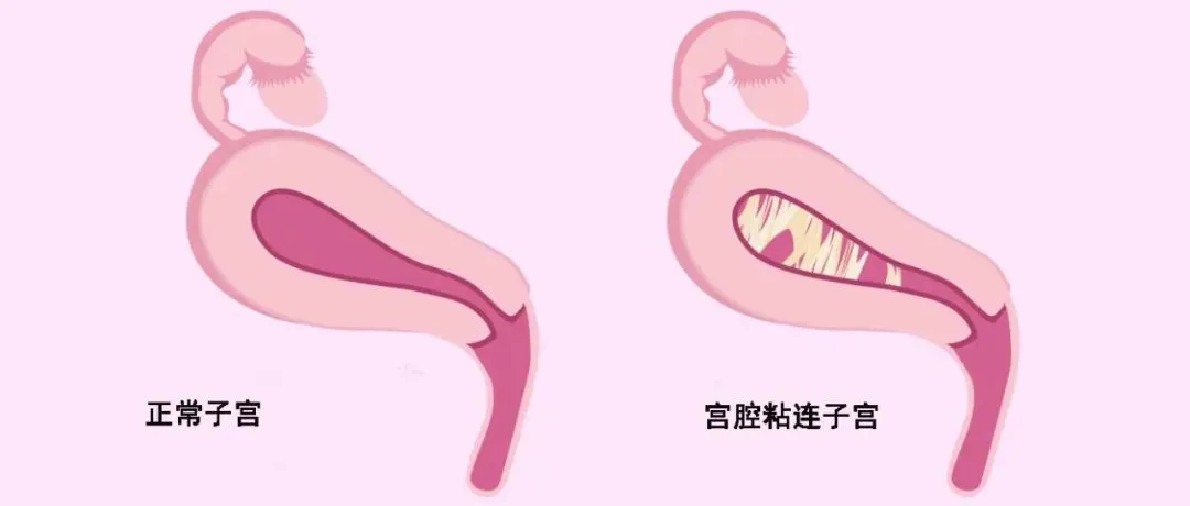 宮腔粘連可以懷孕嗎?一個(gè)典型的試管案例告訴你答案