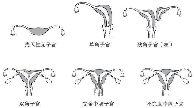 幼稚子宮可以懷孕生娃嗎?試管DY技術助力圓夢