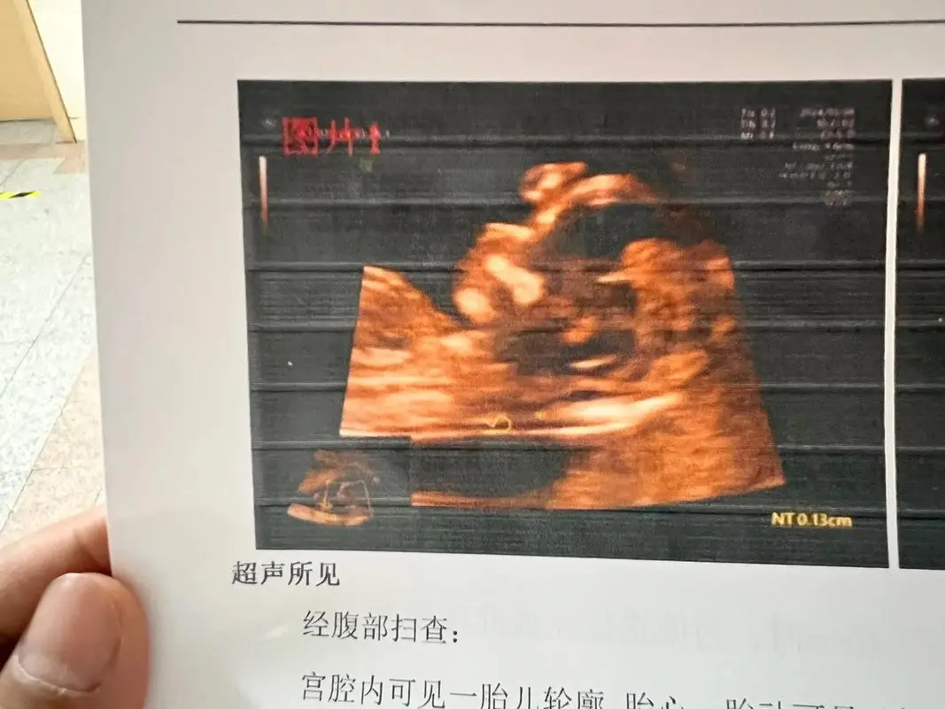 孕期做NT檢查胎兒性別醫(yī)生早就暗示你了