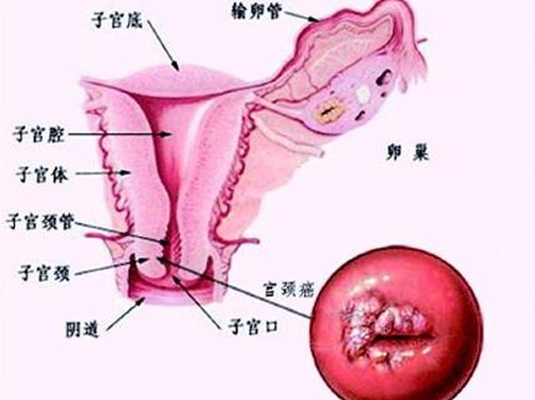 女性宮頸癌早期三處癢是哪些地方?早期這些癥狀表現(xiàn)不可大意