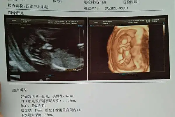 四維彩超看男孩女孩是不是真的?性別不同輪廓區(qū)別你要了解