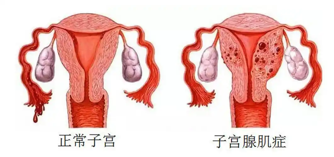 子宮腺肌癥目前最好的治療方法分享，打針吃藥多運(yùn)動都可以