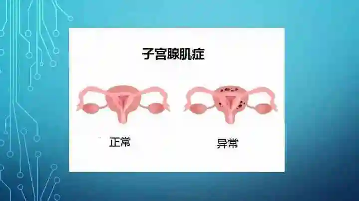 子宮腺肌癥目前最好的治療方法分享，打針吃藥多運(yùn)動都可以